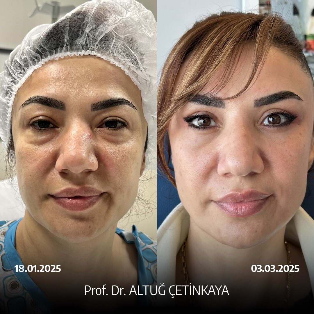 Turkey blepharoplasty example from Prof. Dr. Altug Cetinkaya case 4