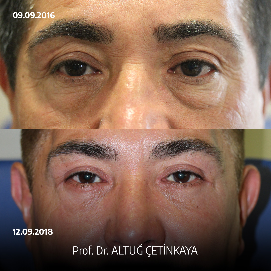 Turkey blepharoplasty example from Prof. Dr. Altug Cetinkaya case 5