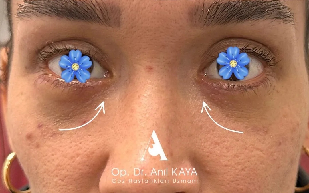 After eyelid surgery example from Dr. Anil Kaya case 1