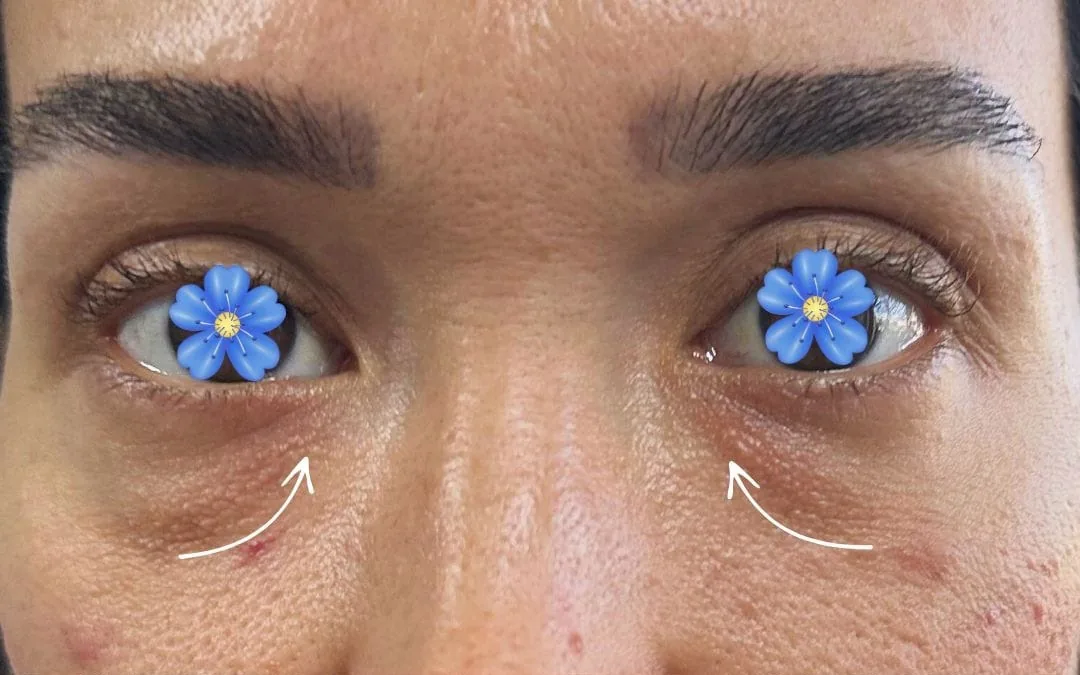 Before eyelid surgery example from Dr. Anil Kaya case 1