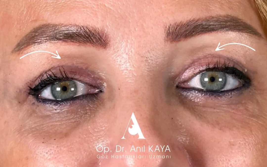 After eyelid surgery example from Dr. Anil Kaya case 2