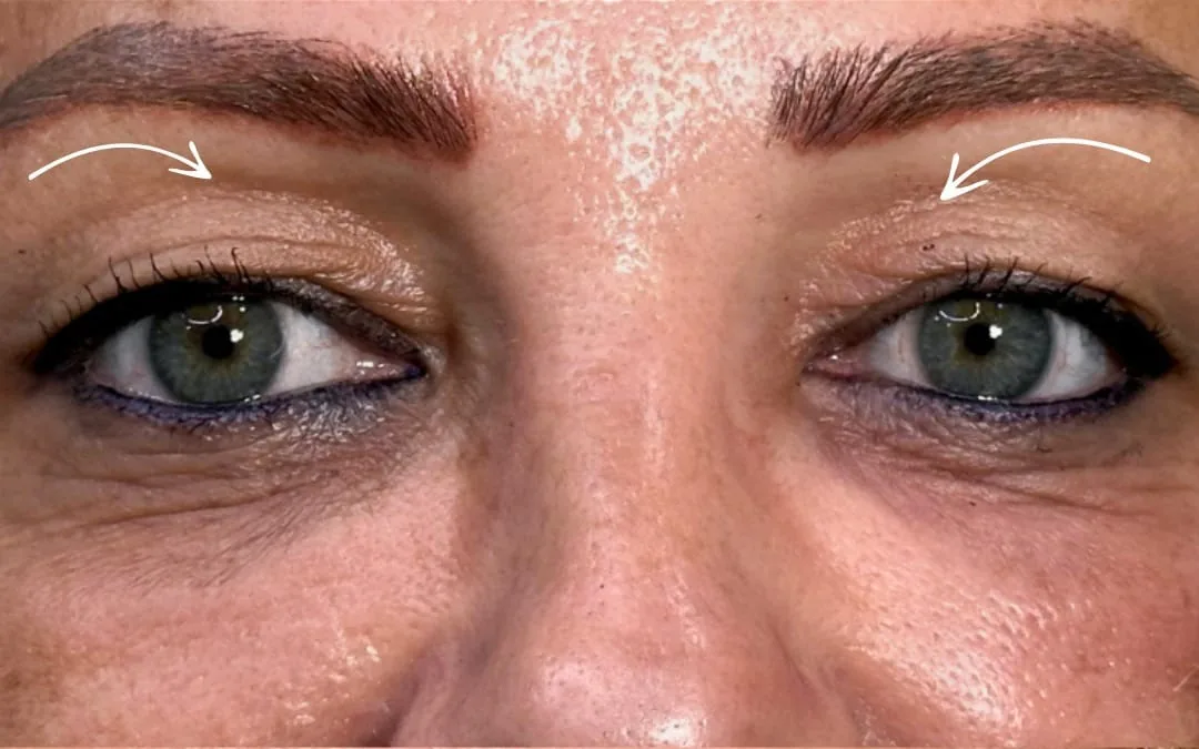 Before eyelid surgery example from Dr. Anil Kaya case 2