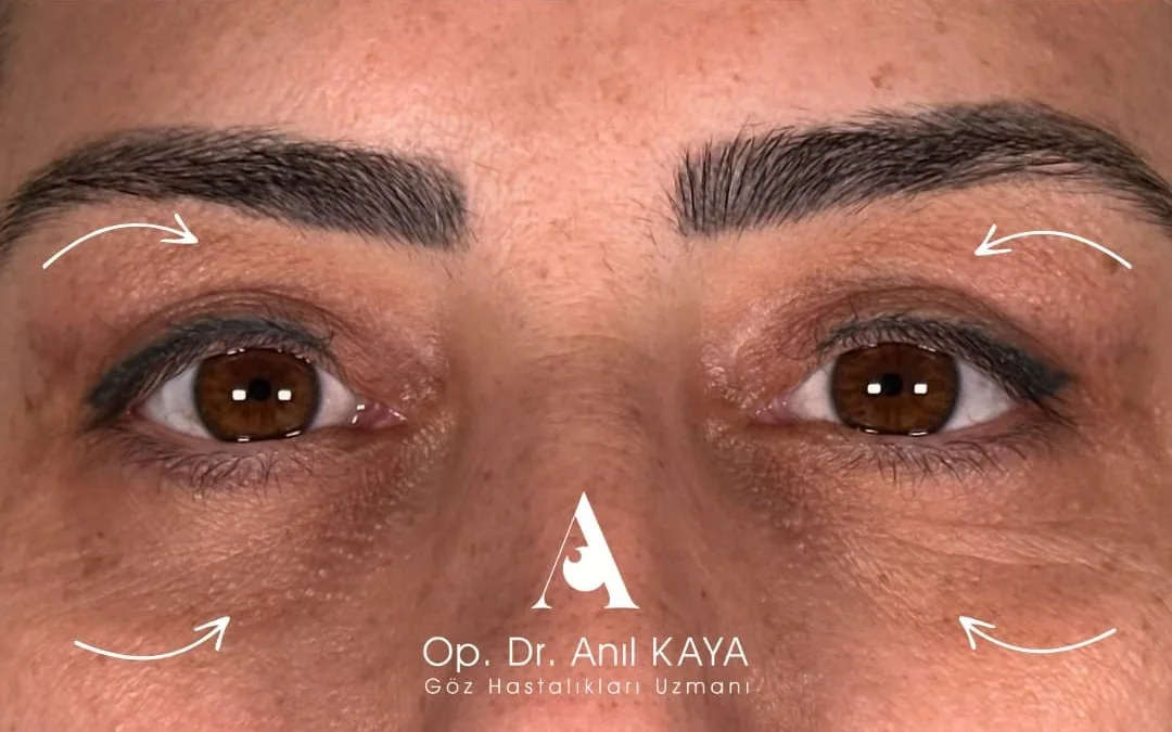 After eyelid surgery example from Dr. Anil Kaya case 3