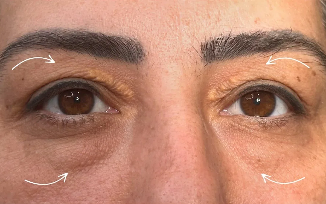 Before eyelid surgery example from Dr. Anil Kaya case 3