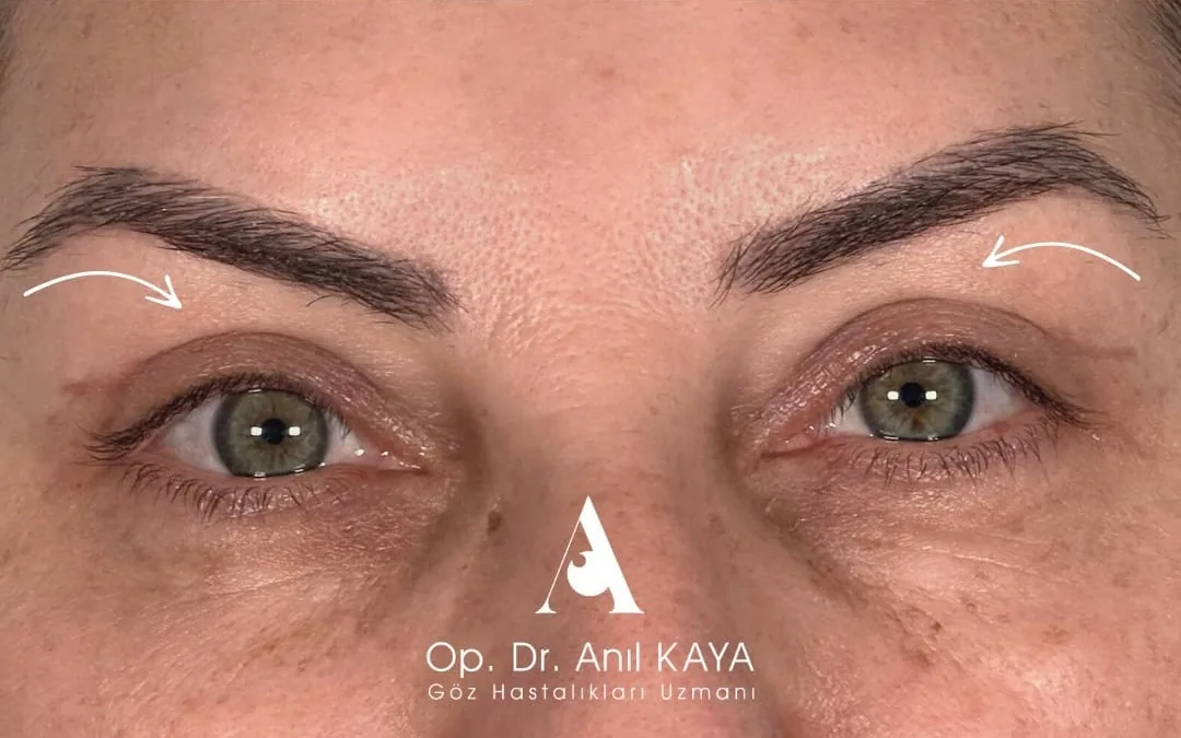 After eyelid surgery example from Dr. Anil Kaya case 4