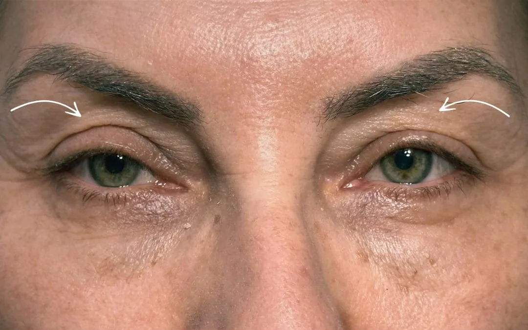Before eyelid surgery example from Dr. Anil Kaya case 4