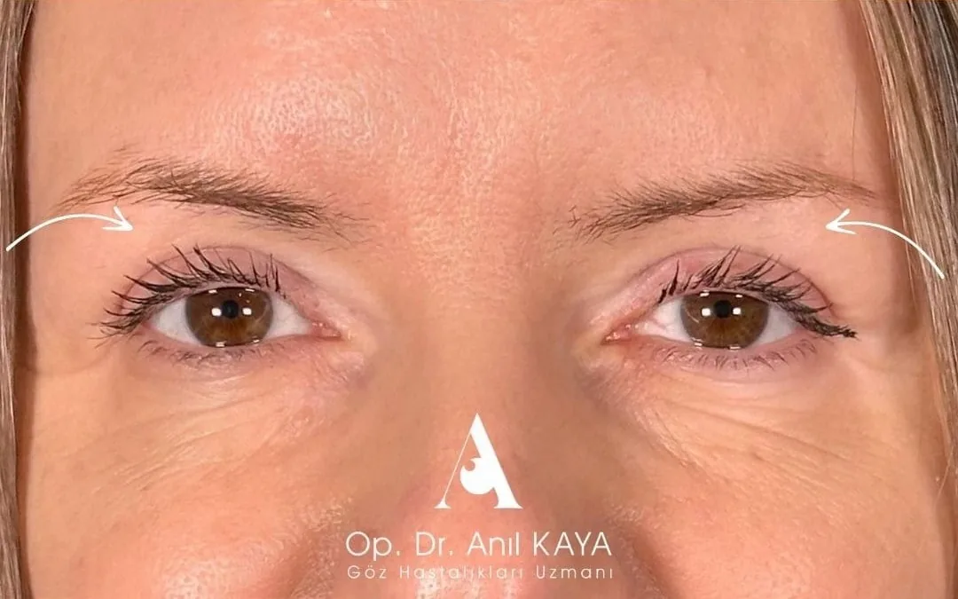 After eyelid surgery example from Dr. Anil Kaya case 5