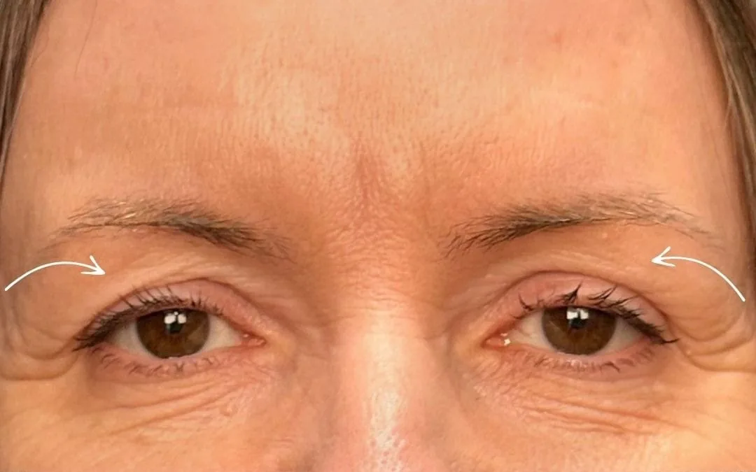 Before eyelid surgery example from Dr. Anil Kaya case 5