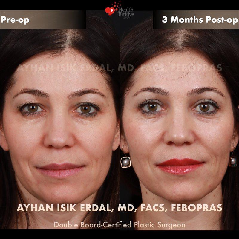 Turkey blepharoplasty example from Ayhan Isik Erdal case 1