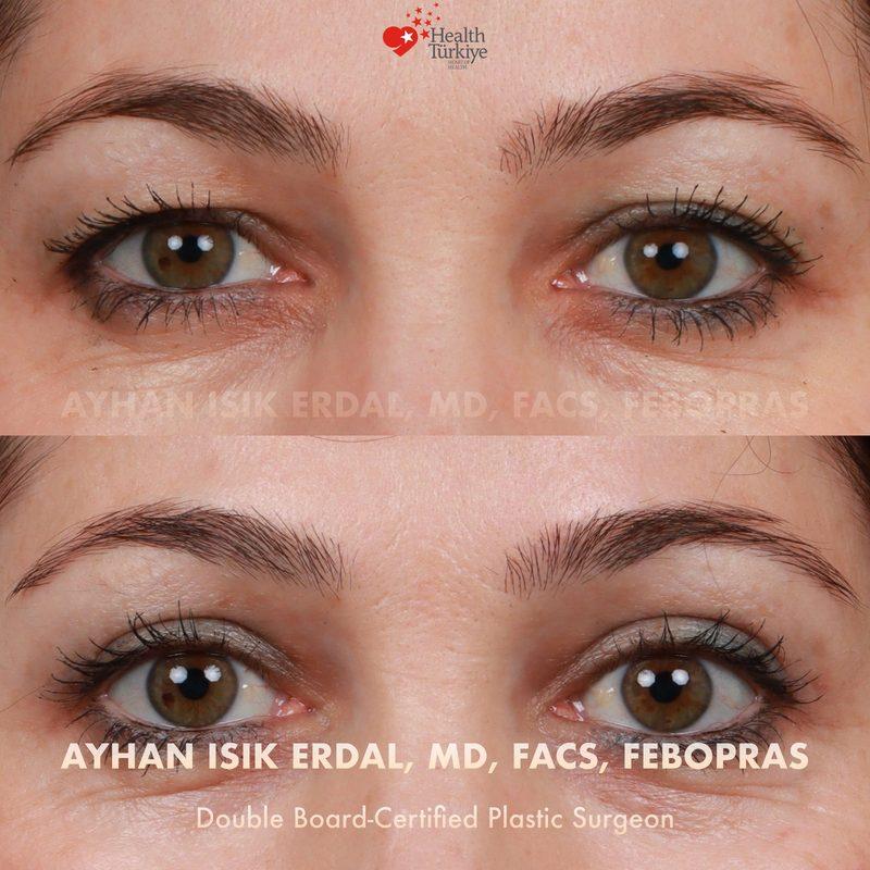 Turkey blepharoplasty example from Ayhan Isik Erdal case 2