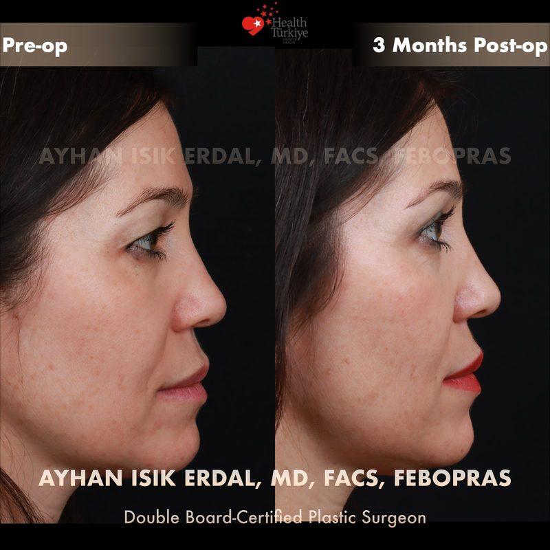 Turkey blepharoplasty example from Ayhan Isik Erdal case 3
