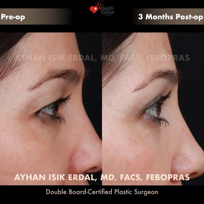 Turkey blepharoplasty example from Ayhan Isik Erdal case 4