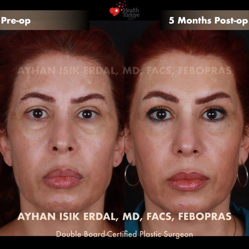 Turkey blepharoplasty example from Ayhan Isik Erdal case 5