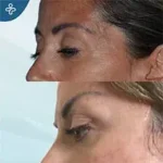 After eyelid surgery example from Care in Turkey case 1