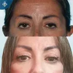 Before eyelid surgery example from Care in Turkey case 1
