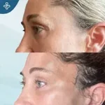 After eyelid surgery example from Care in Turkey case 2