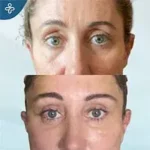 Before eyelid surgery example from Care in Turkey case 2