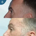After eyelid surgery example from Care in Turkey case 3