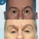 Before eyelid surgery example from Care in Turkey case 3
