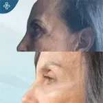After eyelid surgery example from Care in Turkey case 4