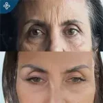 Before eyelid surgery example from Care in Turkey case 4