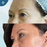 After eyelid surgery example from Care in Turkey case 5