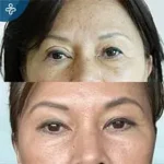 Before eyelid surgery example from Care in Turkey case 5