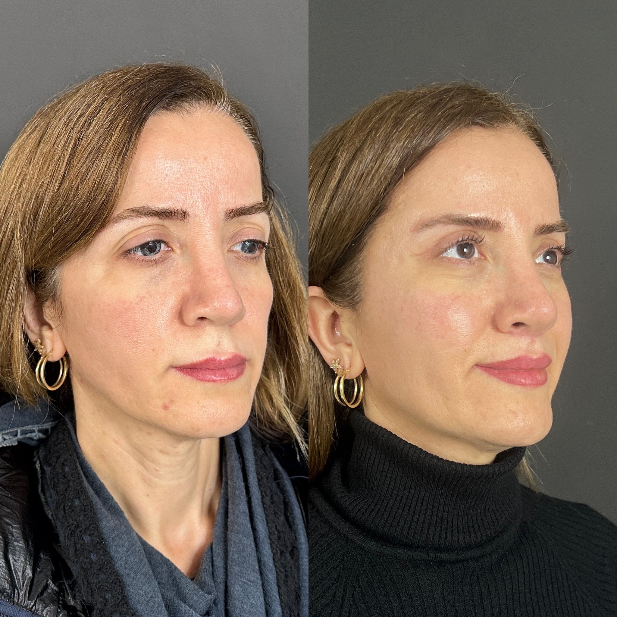 Turkey blepharoplasty example from Dr. Cem Berkay Sinaci case 1