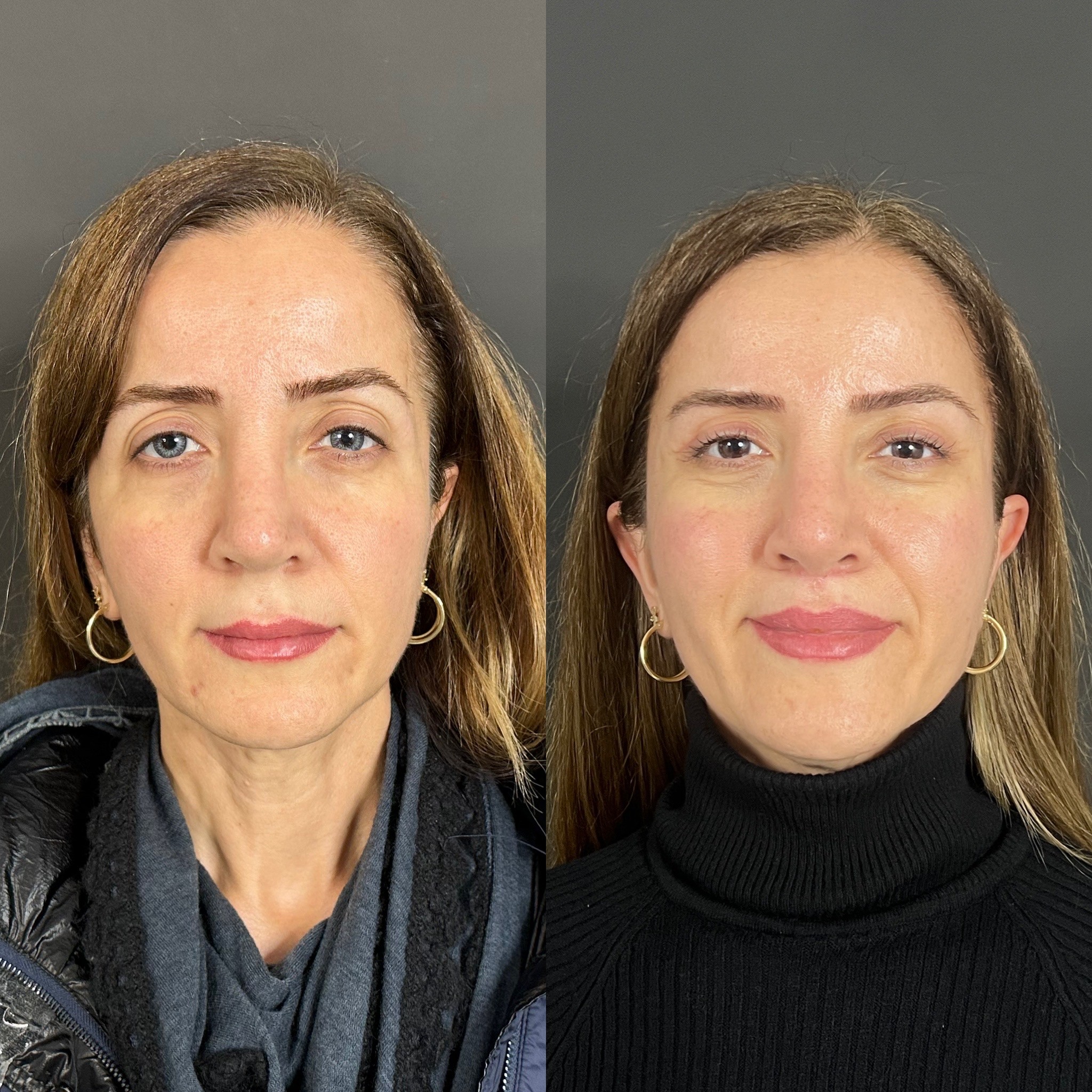 Turkey blepharoplasty example from Dr. Cem Berkay Sinaci case 2