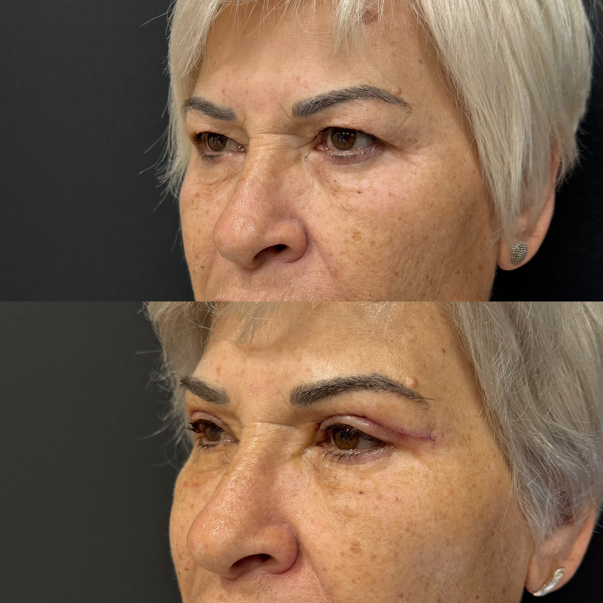 Turkey blepharoplasty example from Dr. Cem Berkay Sinaci case 3