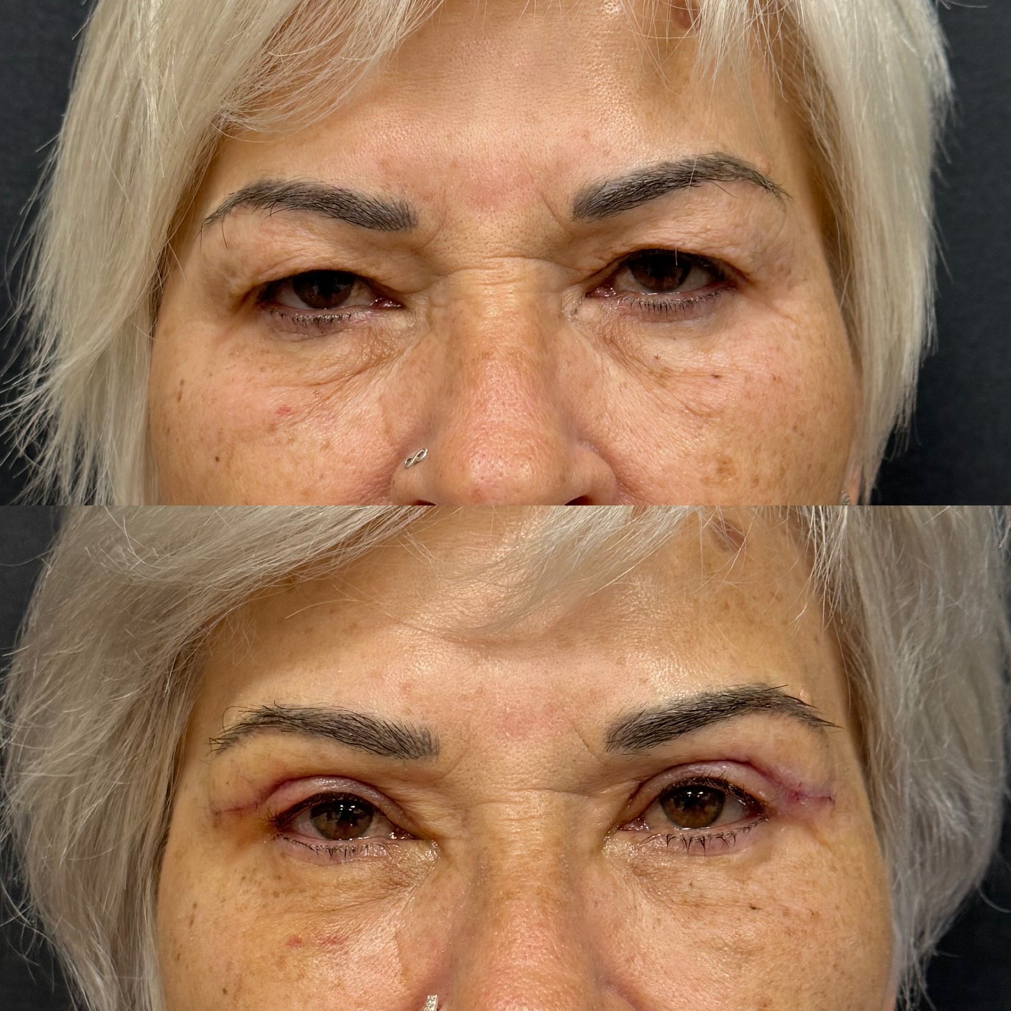 Turkey blepharoplasty example from Dr. Cem Berkay Sinaci case 4