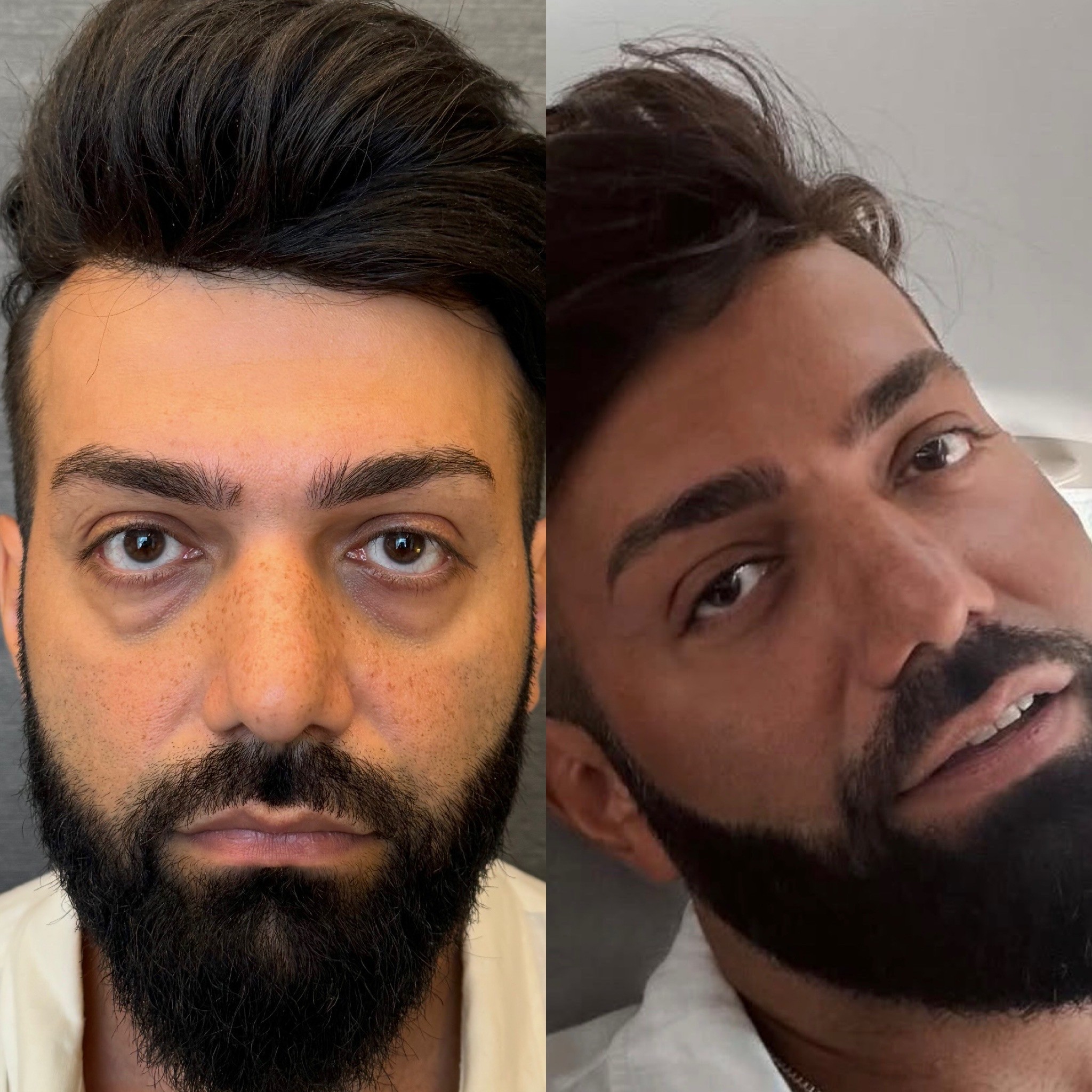 Turkey blepharoplasty example from Dr. Cem Berkay Sinaci case 5