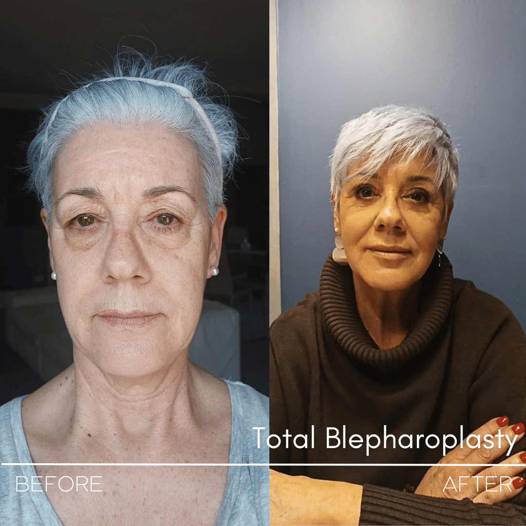 Turkey blepharoplasty example from Estetica Istanbul case 1