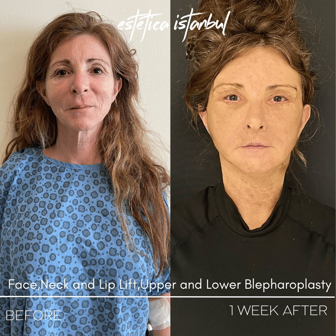 Turkey blepharoplasty example from Estetica Istanbul case 2
