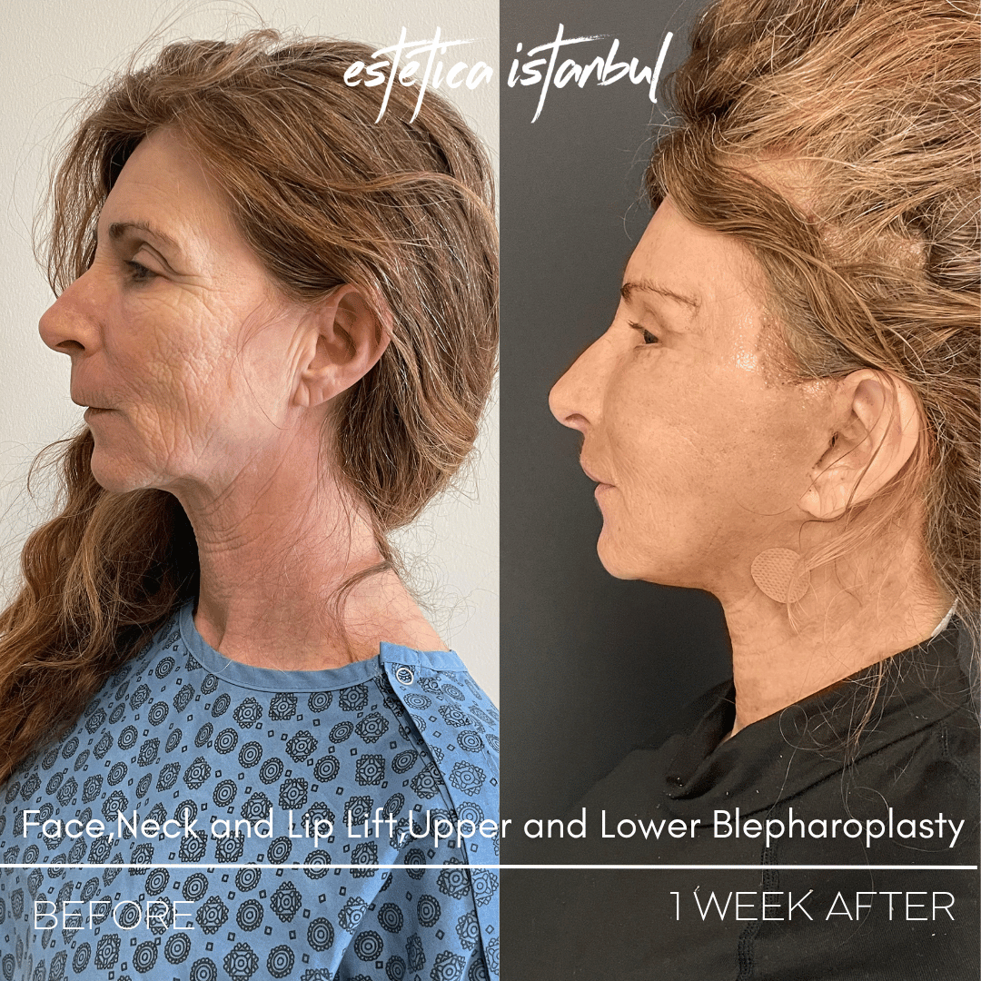 Turkey blepharoplasty example from Estetica Istanbul case 3