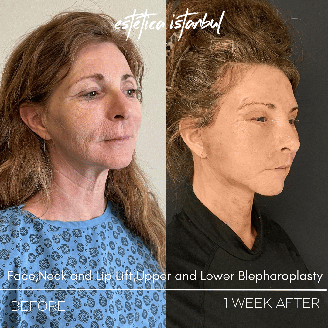 Turkey blepharoplasty example from Estetica Istanbul case 4