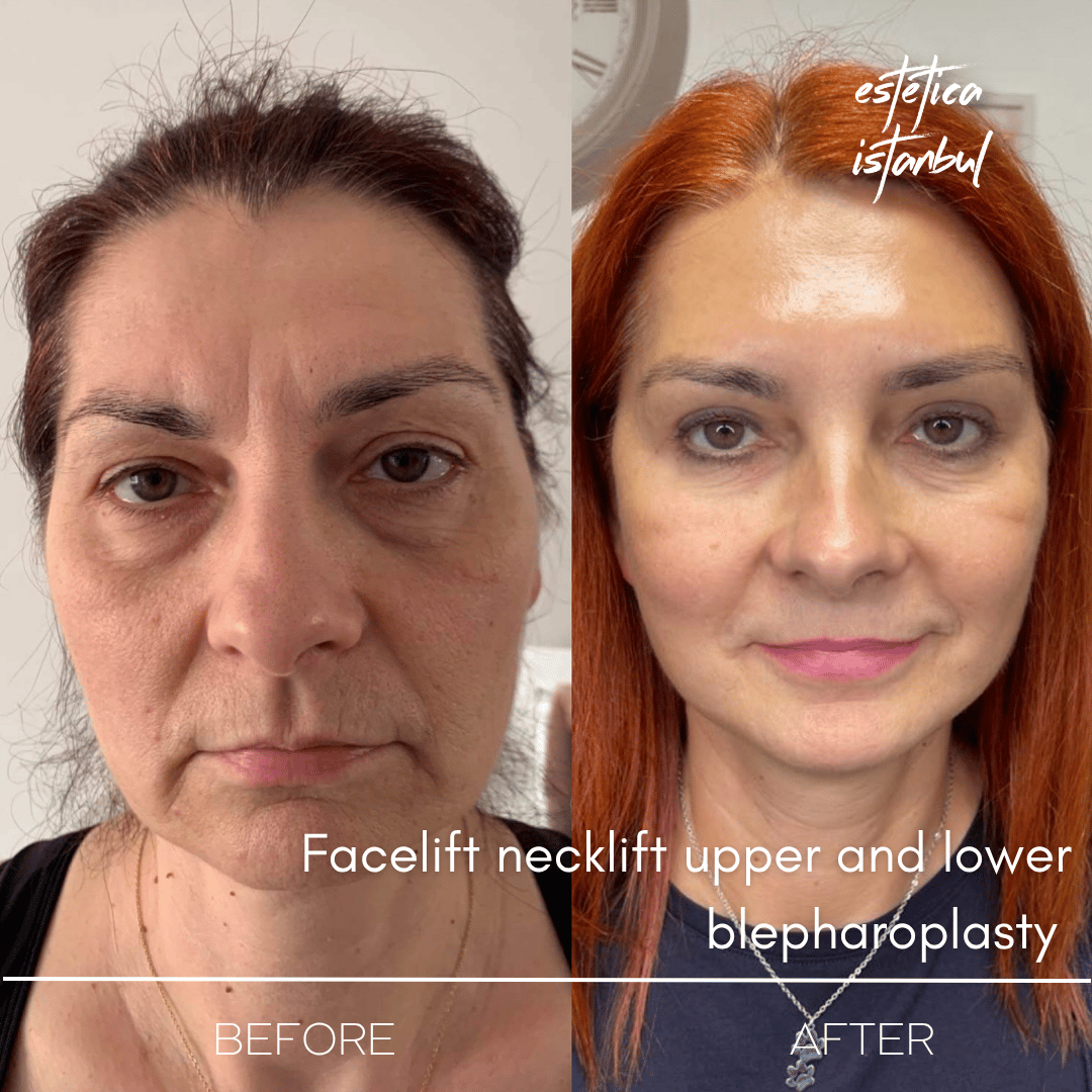 Turkey blepharoplasty example from Estetica Istanbul case 5