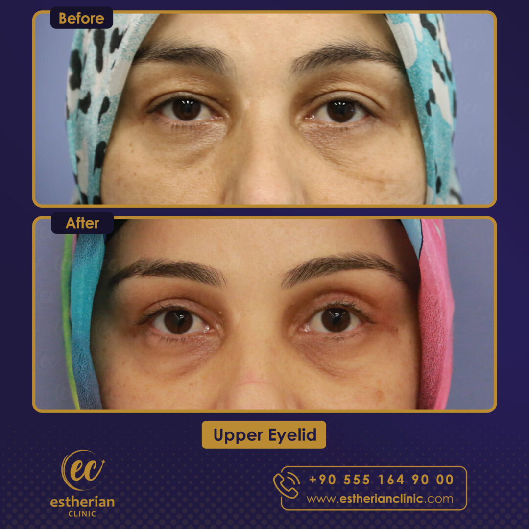 Turkey blepharoplasty example from Estherian Clinic case 1