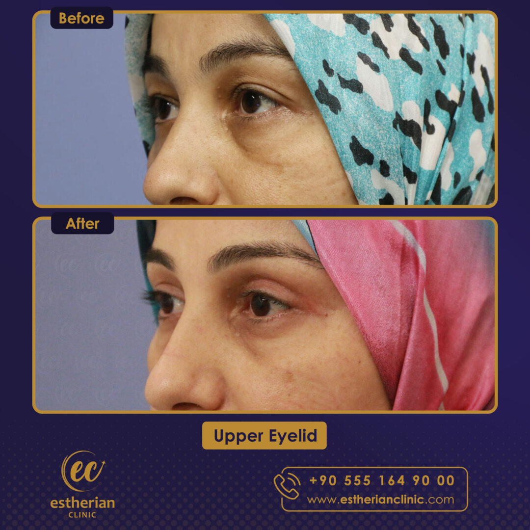 Turkey blepharoplasty example from Estherian Clinic case 2