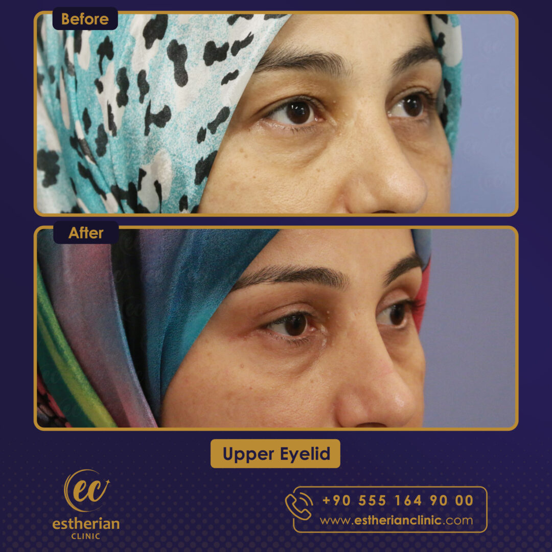 Turkey blepharoplasty example from Estherian Clinic case 3