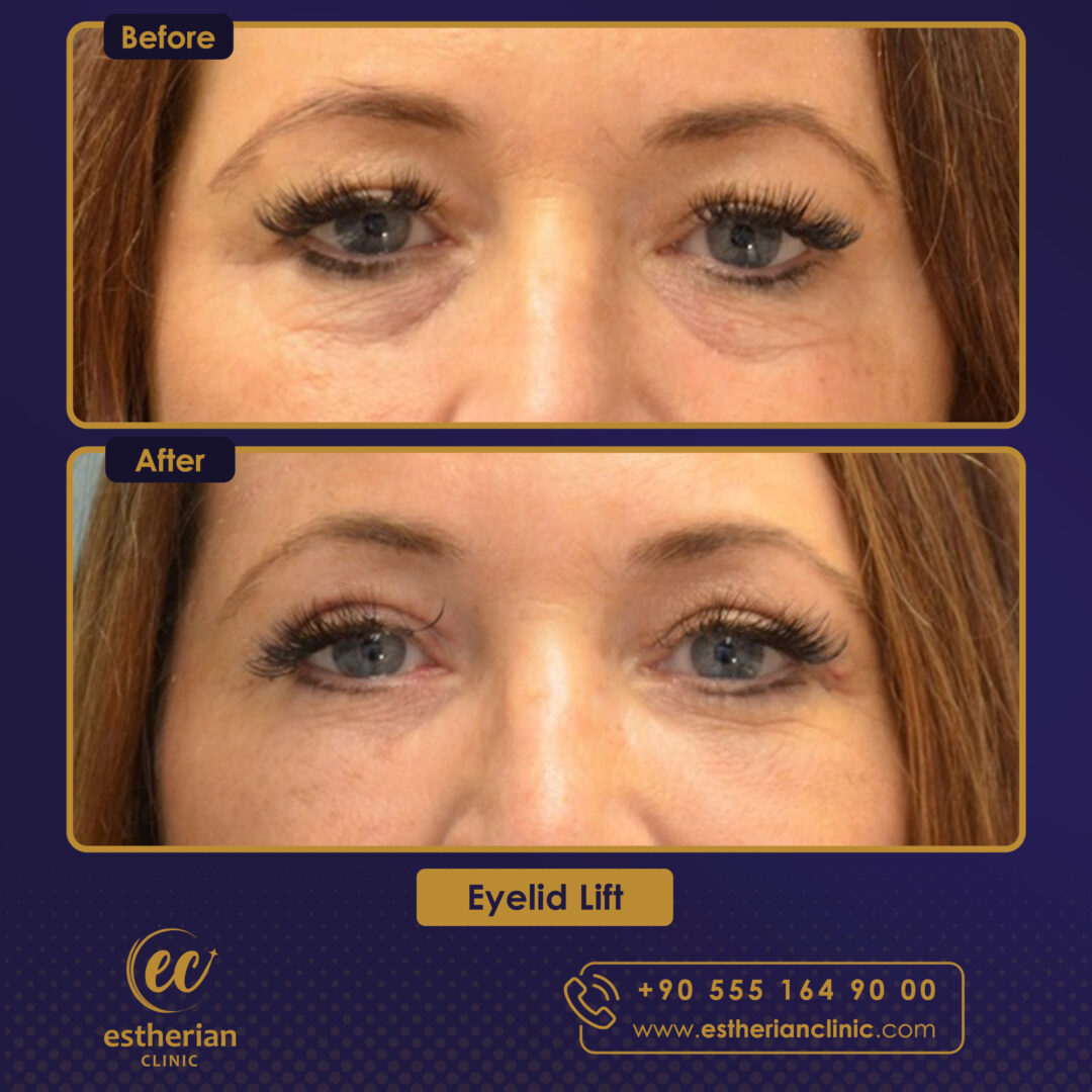 Turkey blepharoplasty example from Estherian Clinic case 4
