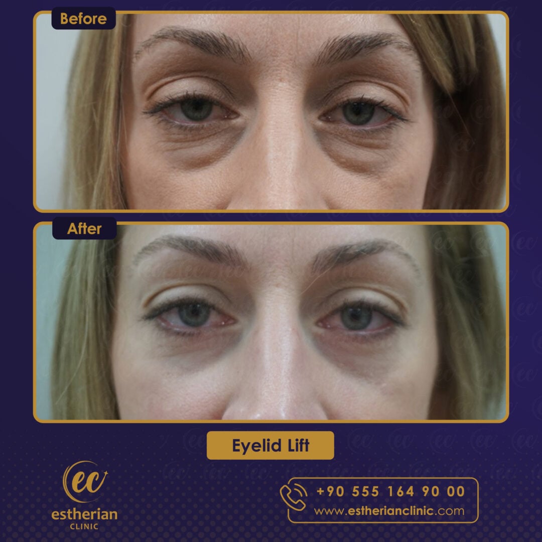 Turkey blepharoplasty example from Estherian Clinic case 5