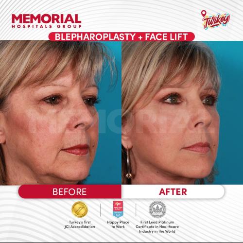 Turkey blepharoplasty example from Turquie Sante source case 1
