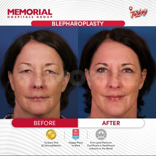 Turkey blepharoplasty example from Turquie Sante source case 2