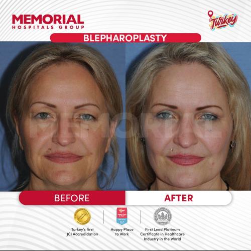 Turkey blepharoplasty example from Turquie Sante source case 3