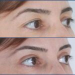 Turkey blepharoplasty example from Turquie Sante source case 4