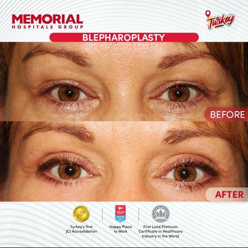 Turkey blepharoplasty example from Turquie Sante source case 5
