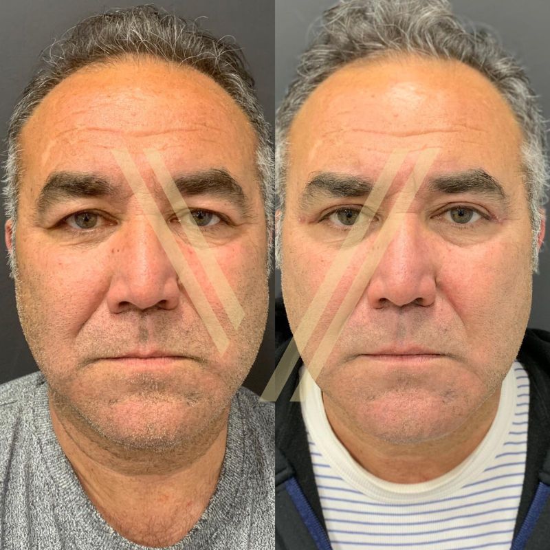 Turkey blepharoplasty example from Vantage Clinic case 1