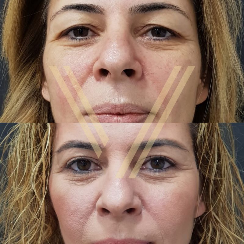 Turkey blepharoplasty example from Vantage Clinic case 2