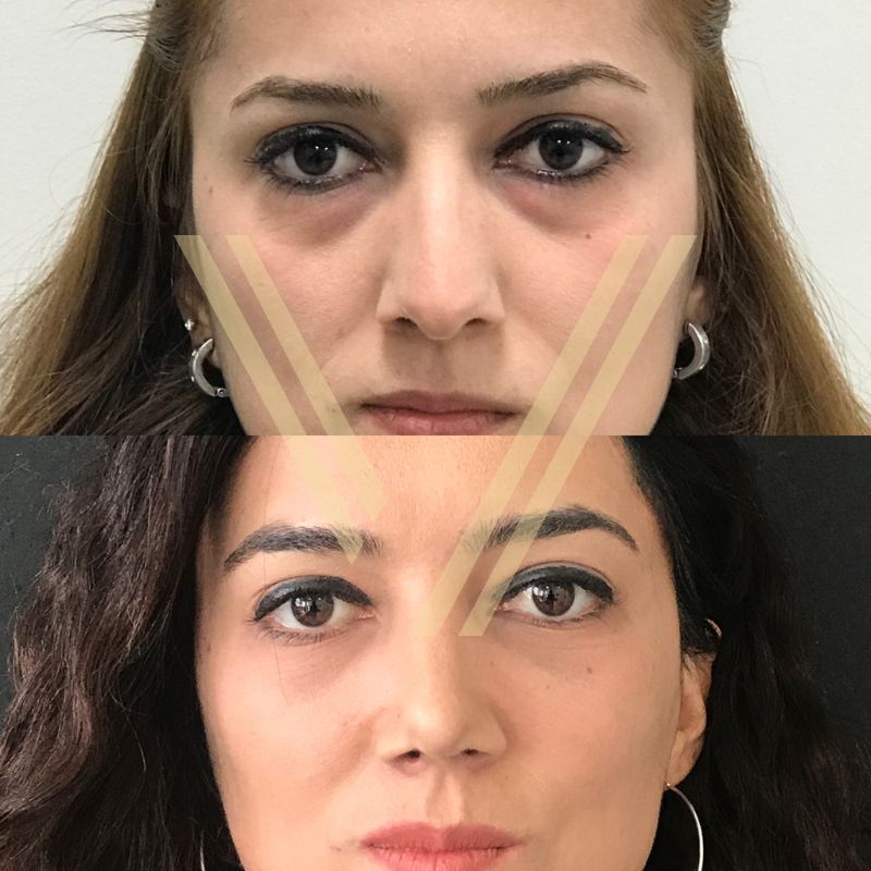 Turkey blepharoplasty example from Vantage Clinic case 3